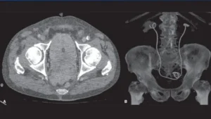 Antegrade DJ Stenting