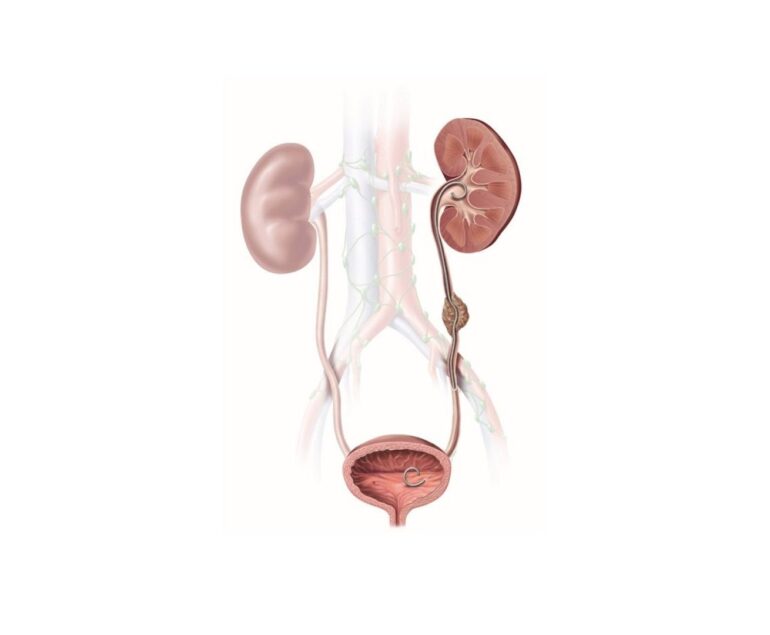 Antegrade DJ Stenting dr rakesh kumawat vascular and interventional radiologist