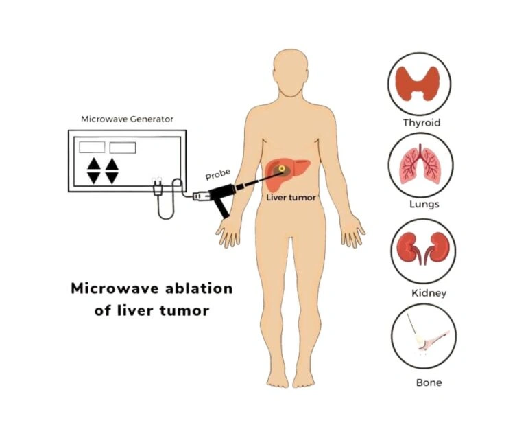 Interventional Oncology microwave ablation dr rakesh kumawat vascular and interventional radiologist