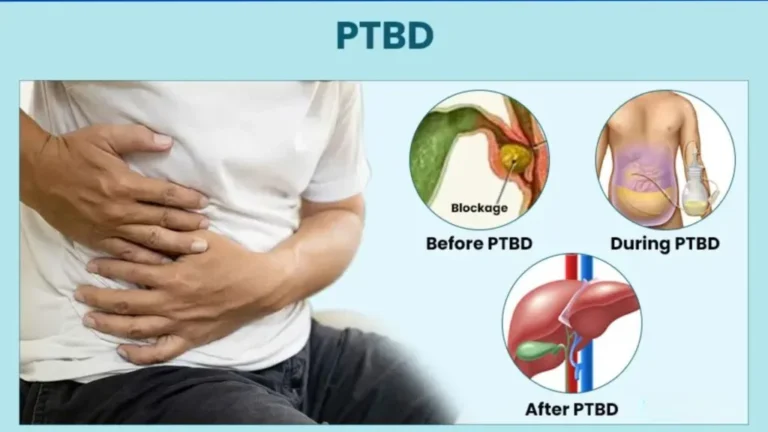 Percutaneous Transhepatic Biliary Drainage (PTBD)​