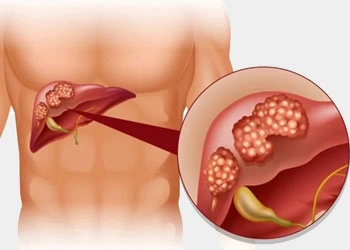 liver-tumour dr rakesh kumawat vascular and interventional radiologist