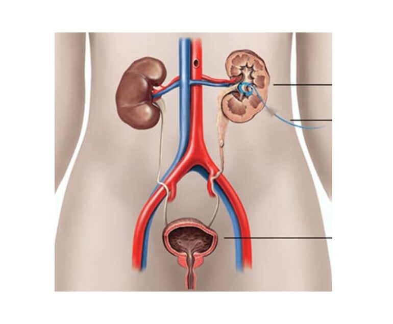 Percutaneous Nephrostomy (PCN) dr rakesh kumawat vascular and interventional radiologist