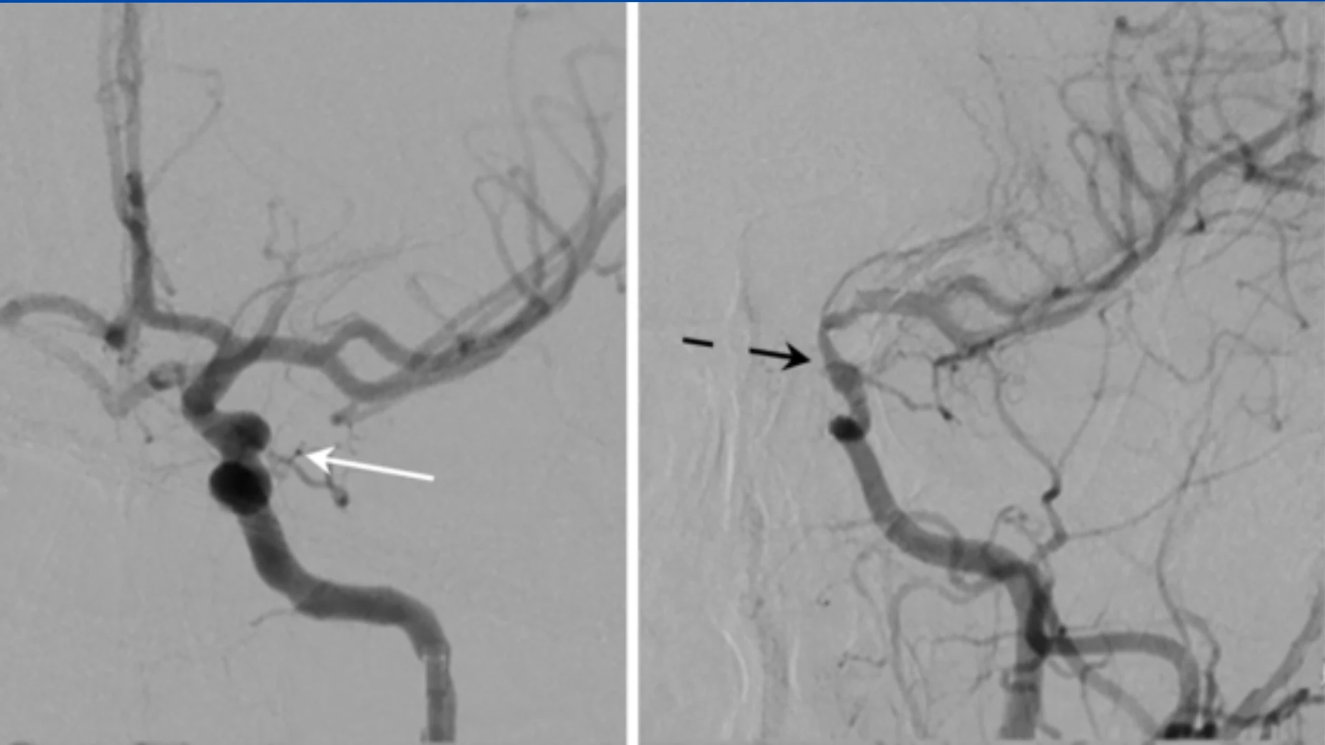 Digital Subtraction Angiography (DSA)