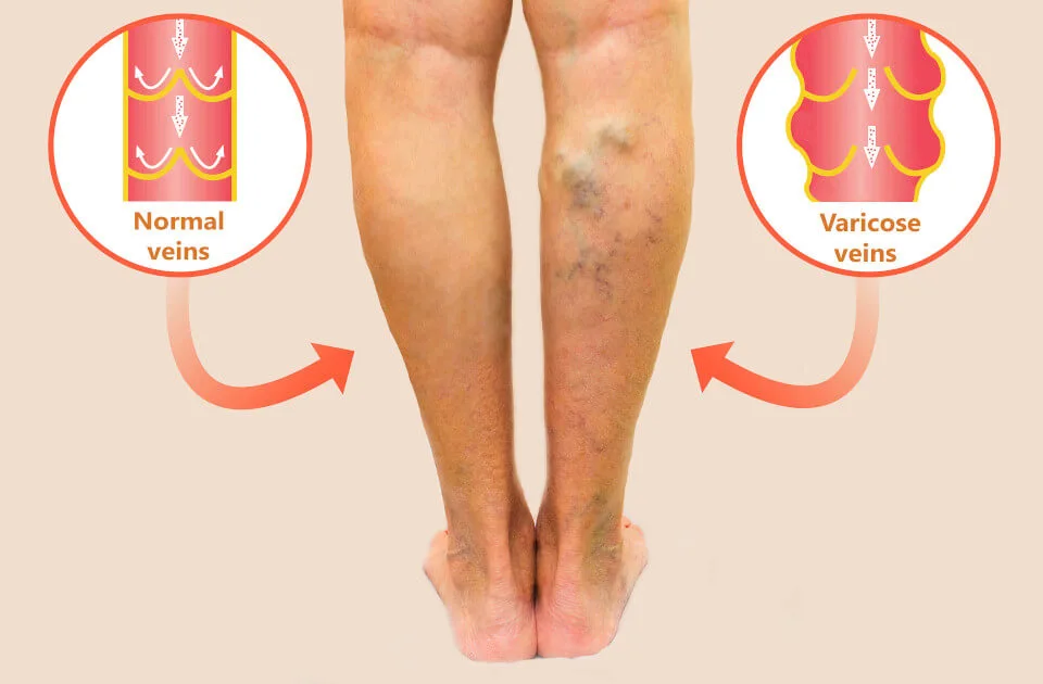 varicose veins Laser treatment
