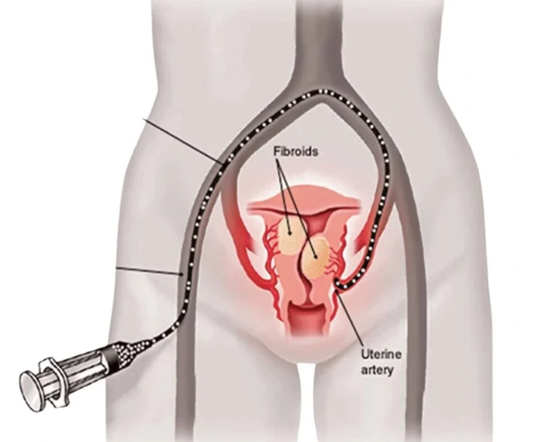 Uterine Fibroid Embolization
