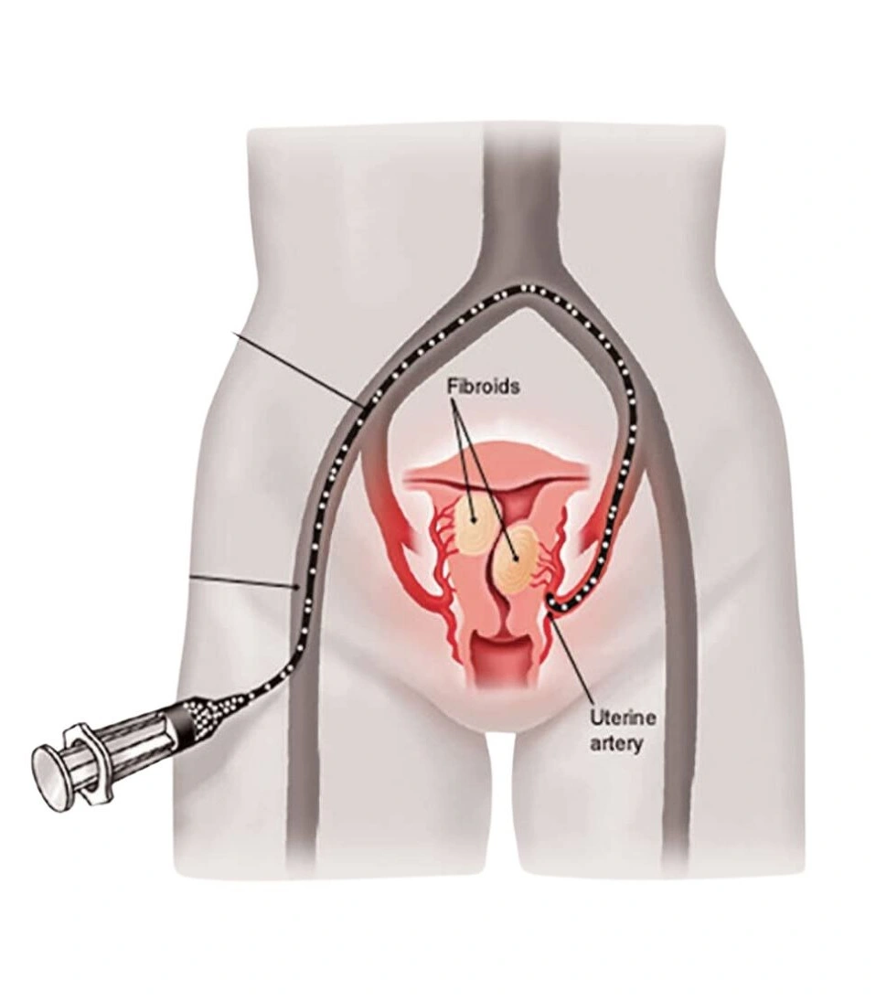 Uterine Fibroid Embolization
