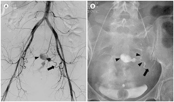 Uterine Artery Embolization