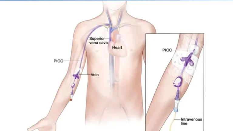 Peripherally inserted central catheter (PICC)