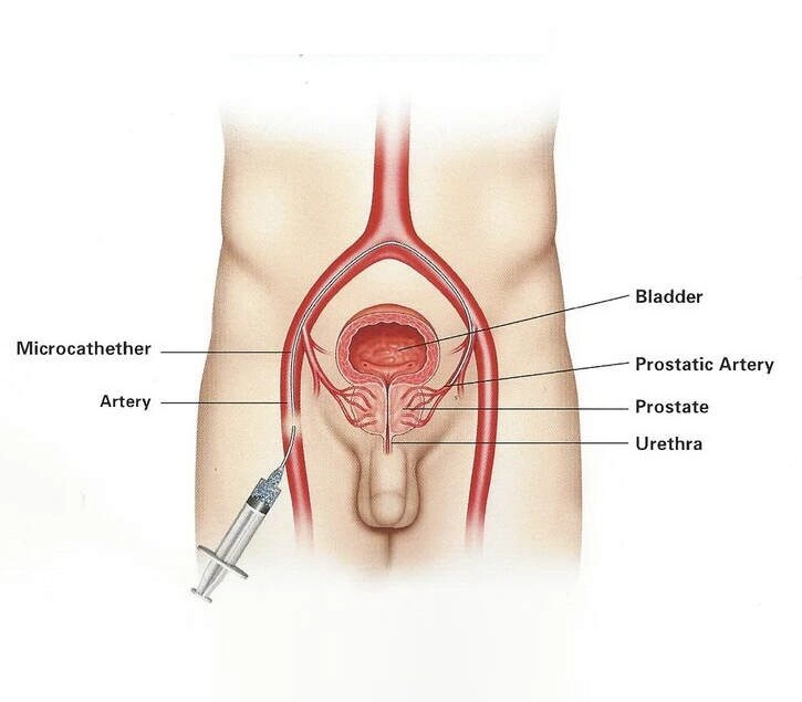 Prostate Artery Embolization