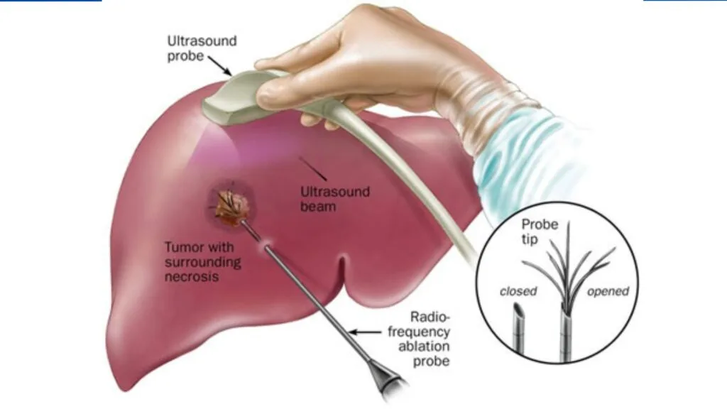 TARE (Transarterial Radioembolization (TARE)