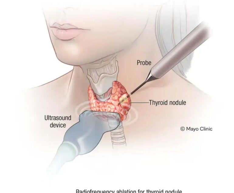 Thyroid Artery Embolization Jaipur