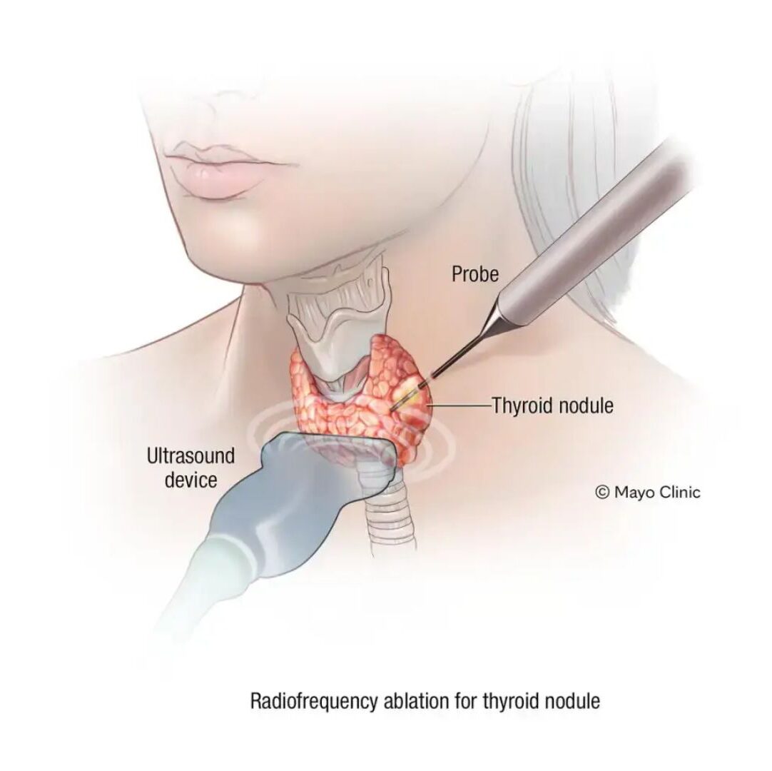 Thyroid Artery Embolization Jaipur