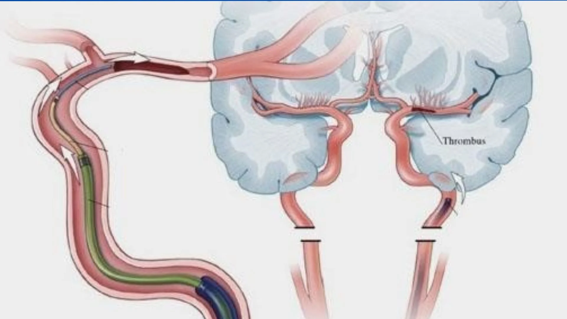 Mechanical Thrombectomy
