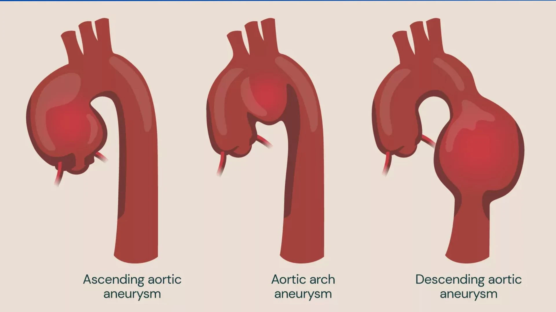 Thoracic Endovascular Aortic Repair (TEVAR)​