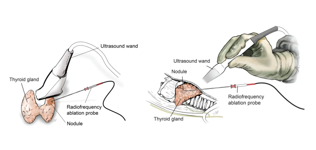 Thyroid Ablation