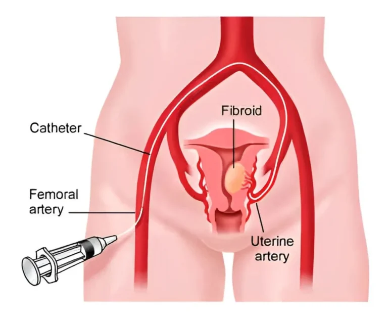 Uterine Artery Embolization