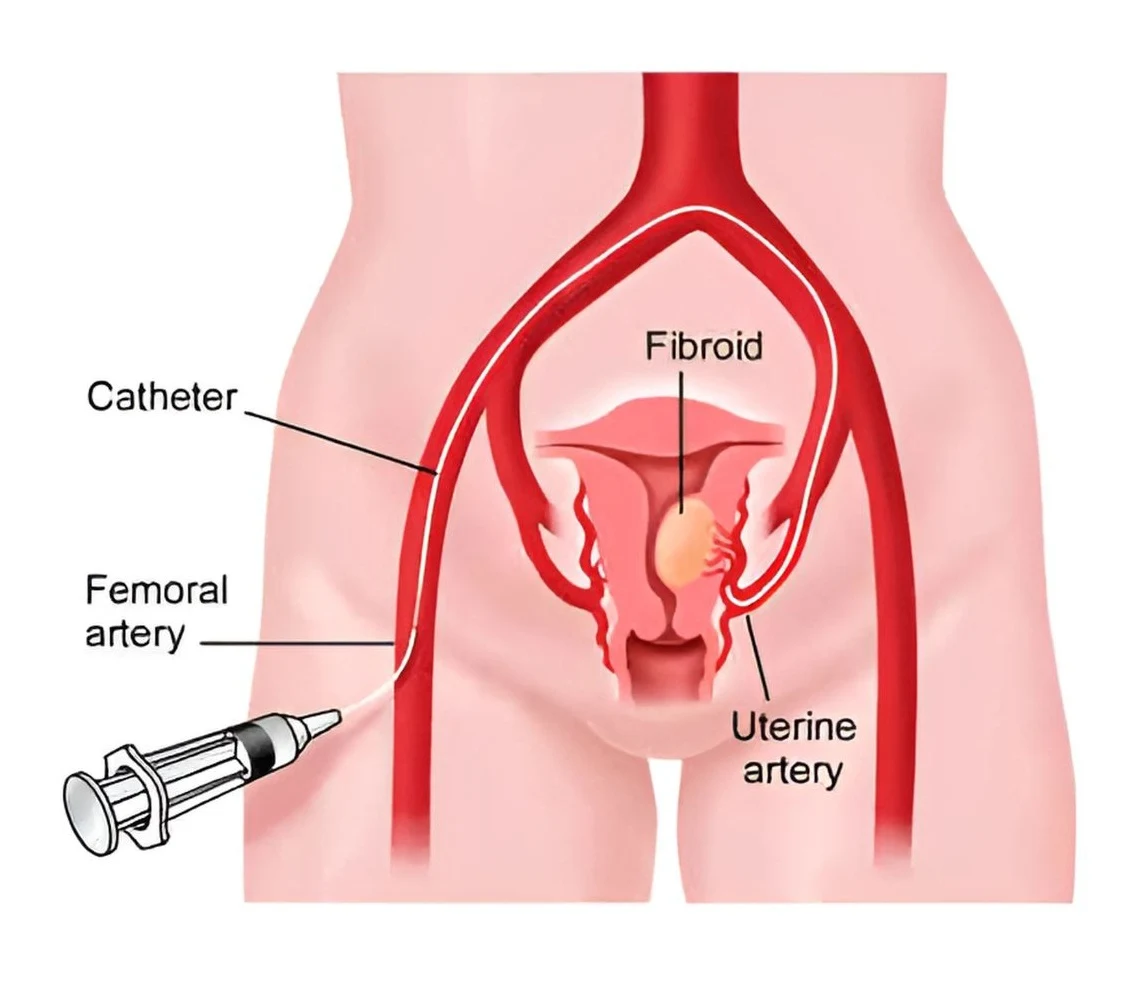 Uterine Artery Embolization