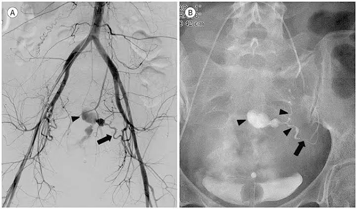 Uterine Artery Embolization (UAE)​