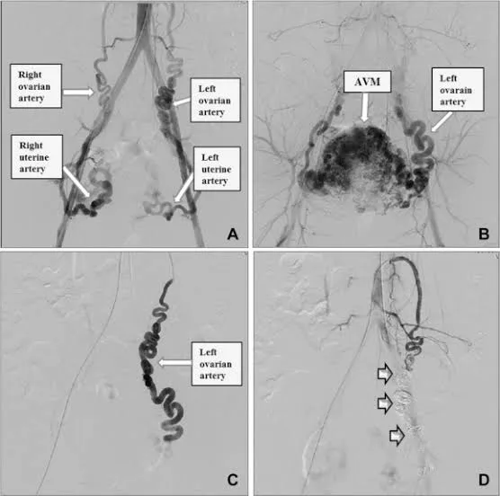 Uterine Artery Embolization (UAE)​