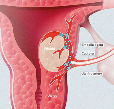 Uterine Fibroid Embolization (UFE)