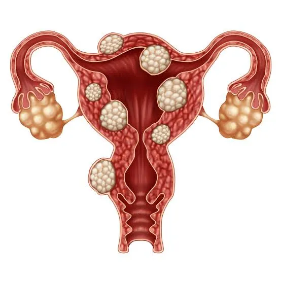 Uterine Fibroid Embolization (UFE)