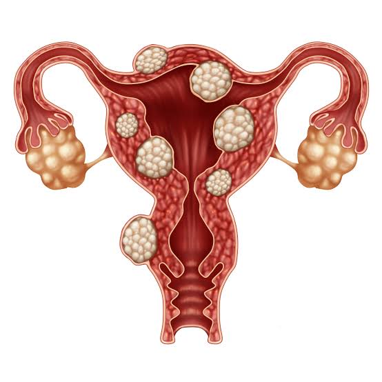 Uterine Fibroid Embolization