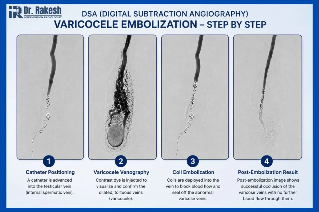 Step-by-step DSA images of varicocele embolization treatment in Jaipur showing catheter positioning, varicocele venography, coil embolization, and post-embolization results for non-surgical varicocele treatment in Rajasthan.