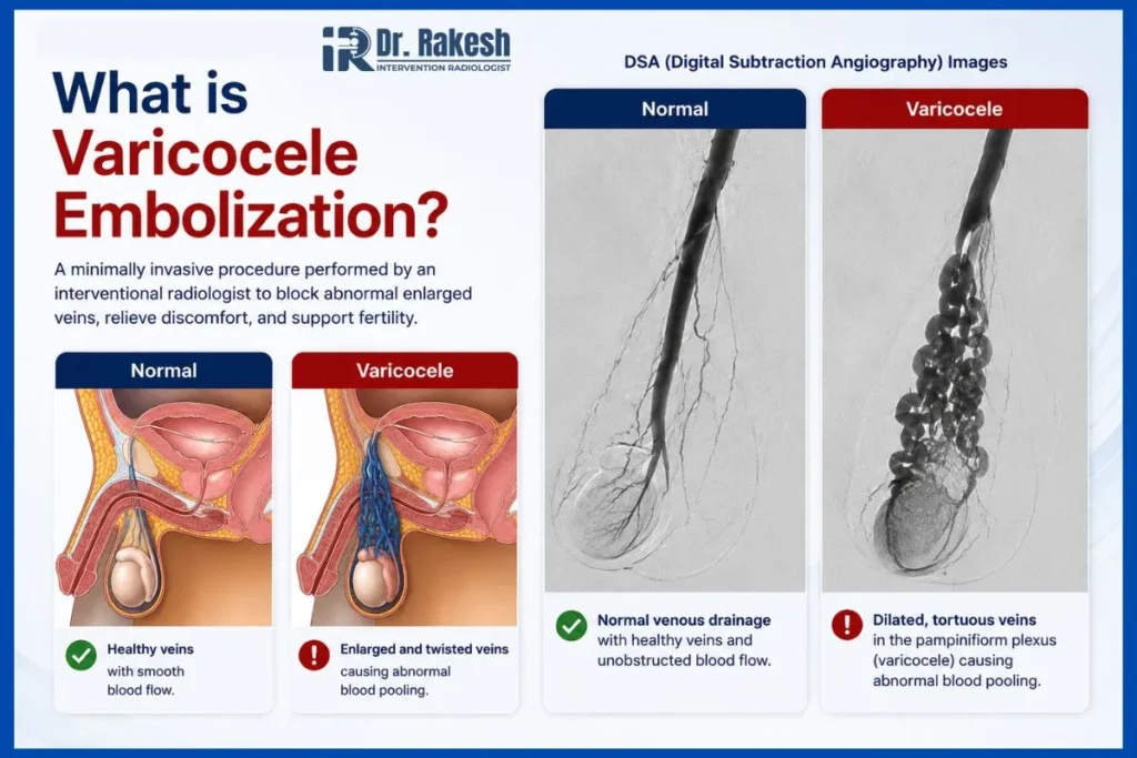 Educational image explaining varicocele embolization treatment in Jaipur with comparison of normal veins and varicocele veins using DSA angiography images and medical illustrations in Rajasthan.