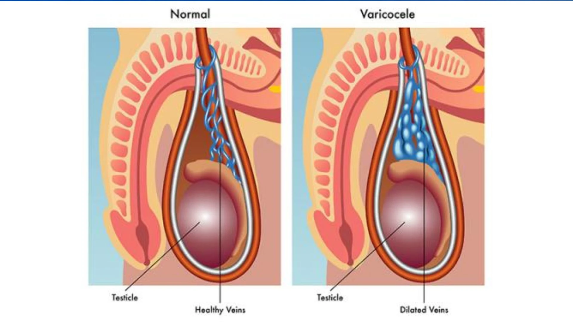 Varicocele Embolization