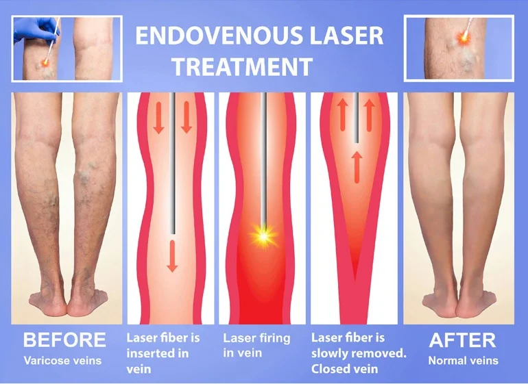 Varicose Vein Laser Treatment in Jaipur showing before and after leg veins