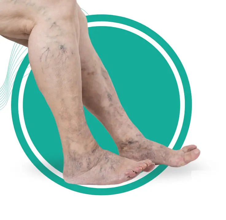 Varicose Vein