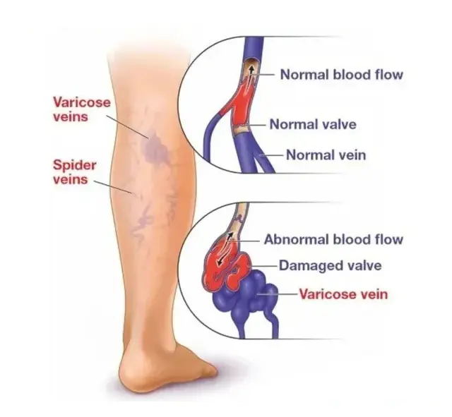 Varicose-Vein img