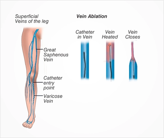 varicose veins Laser treatment
