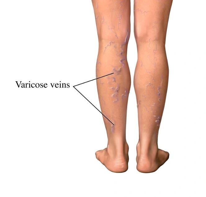 Varicose Veins