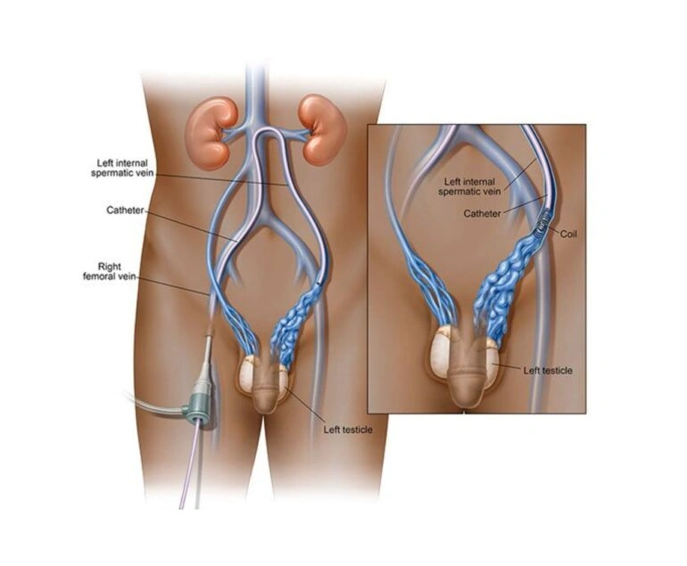 Vascular Arterial And Venous Varicocele Embolization dr rakesh kumawat vascular and interventional radiologist