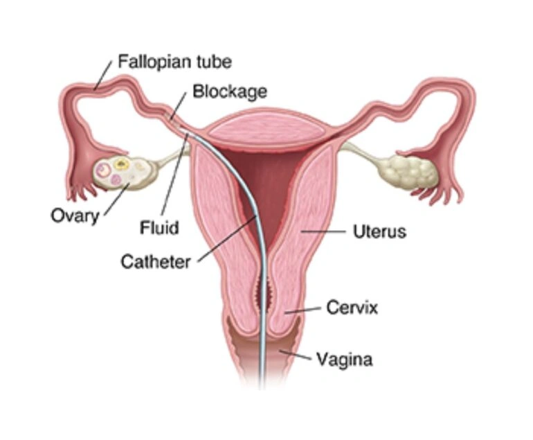 fallopian tube obs dr rakesh kumawat vascular and interventional radiologist