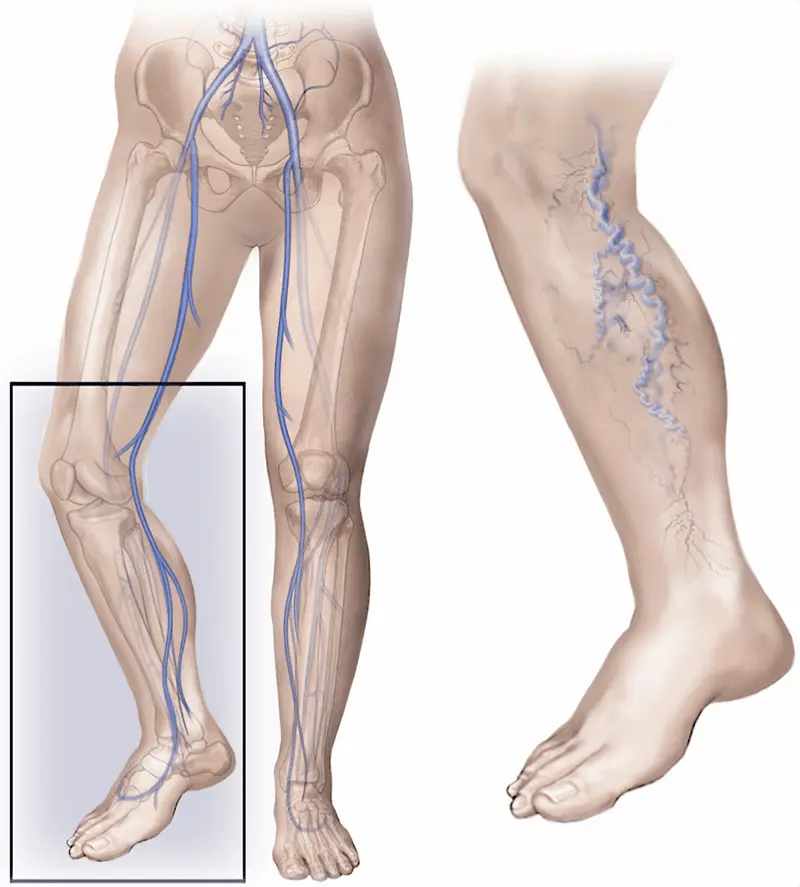 varicose vein