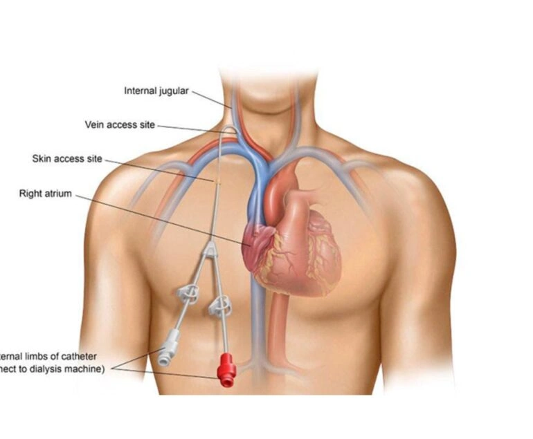 vascular artery Permacath Placement dr rakesh kumawat vascular and interventional radiologist