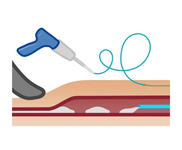vascular artery Venaseal Treatment dr rakesh kumawat vascular and interventional radiologist