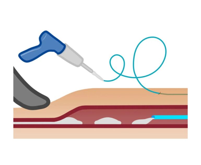 vascular artery Venaseal Treatment dr rakesh kumawat vascular and interventional radiologist