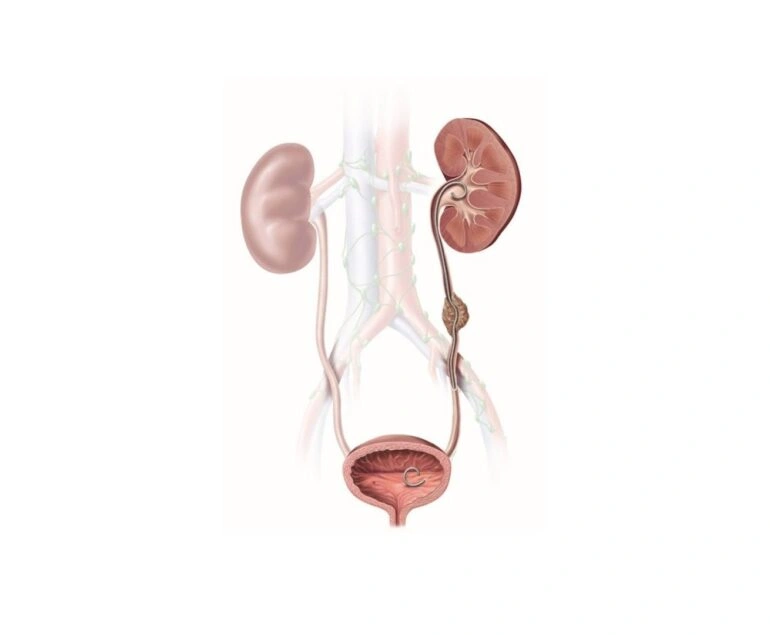 Antegrade DJ Stenting dr rakesh kumawat vascular and interventional radiologist