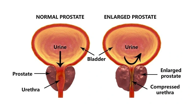 Prostate Artery Embolization