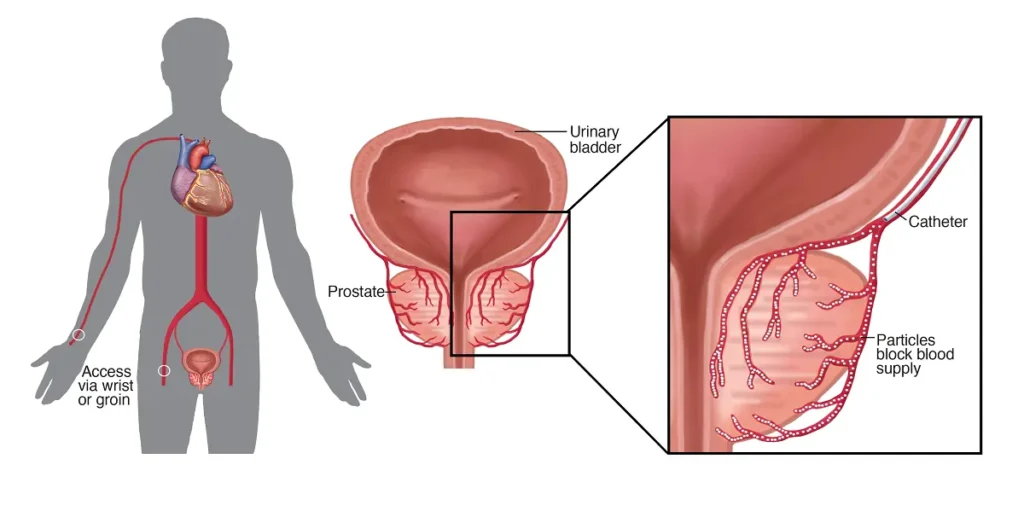 Enlarged prostate or benign prostatic