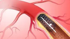 Genicular-Artery-Embolization