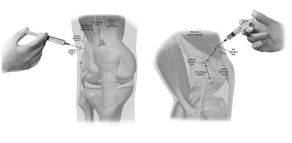 genicular nerve block