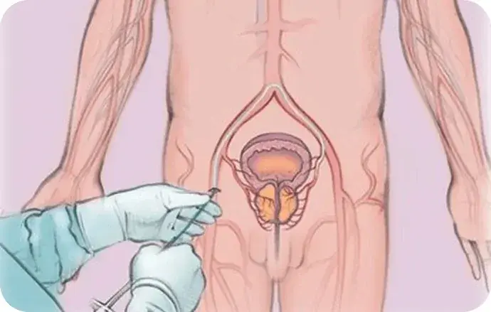 Prostate Artery Embolization