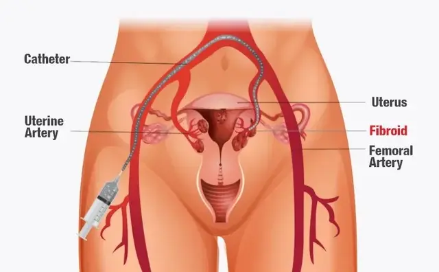 Prostate Artery Embolization