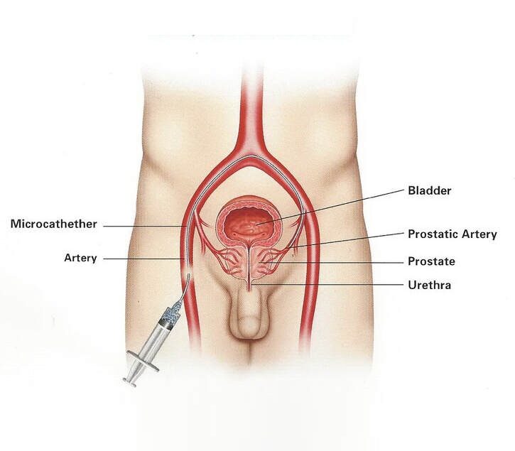 Prostate Artery Embolization