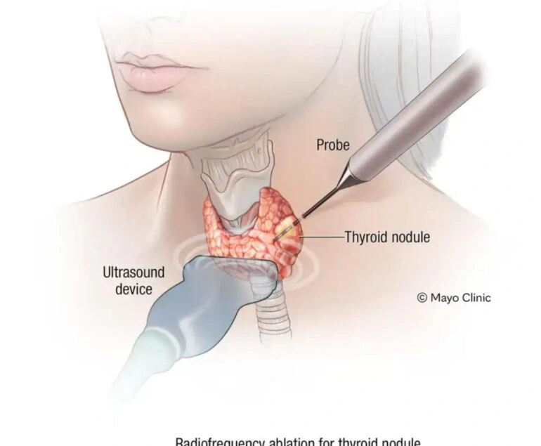 Thyroid Ablation Treatment in Jaipur using minimally invasive radiofrequency ablation for safe and effective thyroid nodule treatment