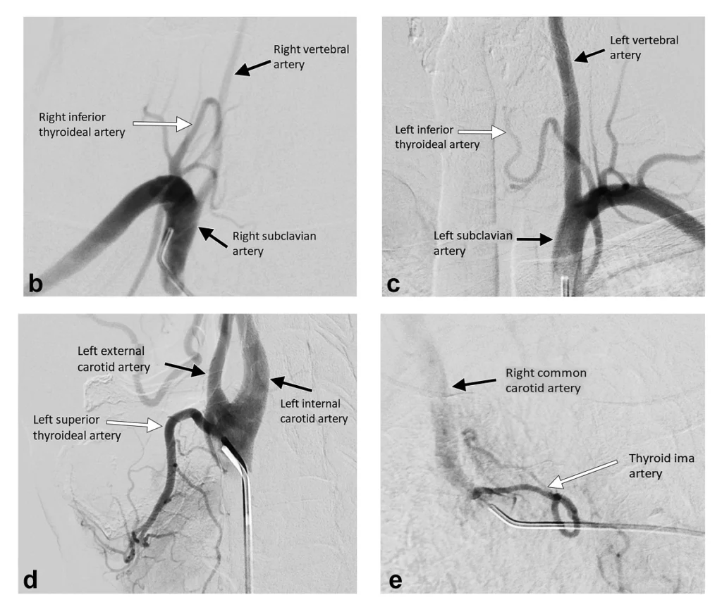 Thyroid Artery Embolization